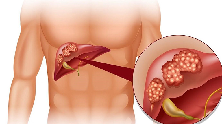 Điều Trị Bệnh Gan Bằng Y Học Cổ Truyền